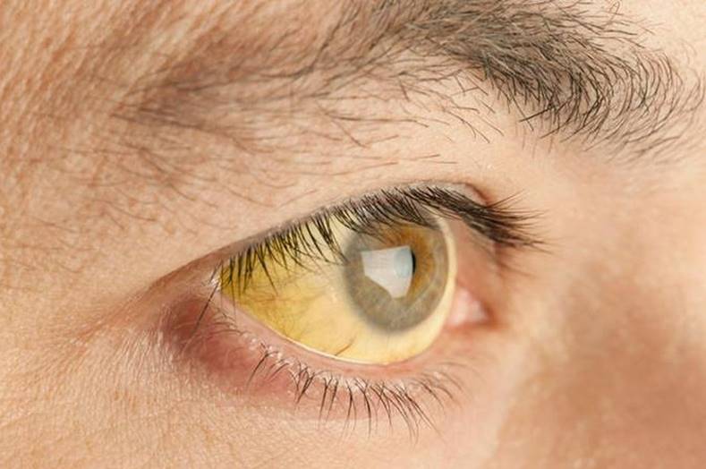 morte febre amarela santa catarina